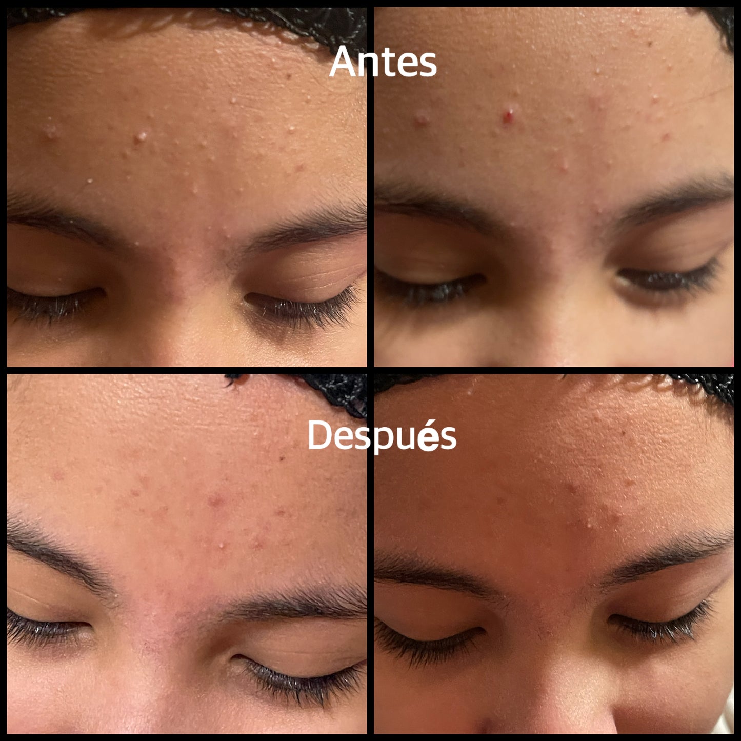 Jabón para manchas & espinillas